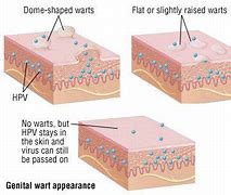 Image result for Genital Warts Itchy