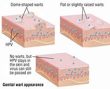 Image result for Genital Warts Skin Tags