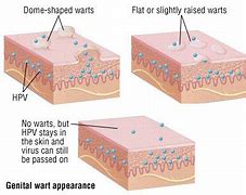 Image result for Signs of Genital Warts in Women