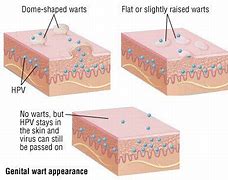 Image result for Do Genital Warts Hurt
