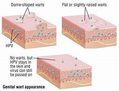 Image result for Mild Genital Warts