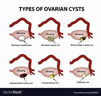 Image result for Ovarian Cyst Warning Signs