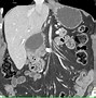 Image result for Pancreas Tumor CT