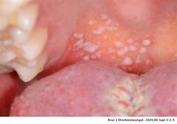 Image result for Chronic Oral Candidiasis