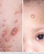 Image result for One Only Molluscum Contagiosum