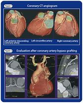 Image result for CT Coronary Angiogram
