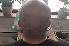 Image result for Laser Hair Removal Scalp
