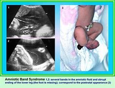 Image result for Amniotic Band Syndrome Ultrasound