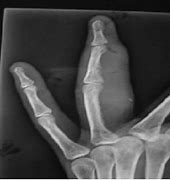 Image result for Swollen Ring Finger Knuckle
