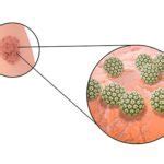 Image result for HPV Warts Disease
