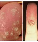 Image result for HPV Cauliflower Wart