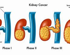 Image result for Cancer Kidney Stones