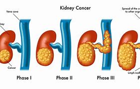 Image result for Kidney Cancer Tumor