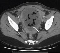 Image result for Enlarged Uterus and Fibroids