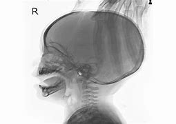 Image result for Hydrocephalus Skull