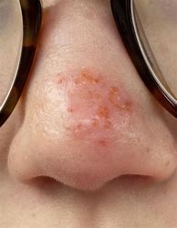 Image result for Sunburn with Scabs