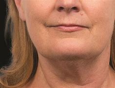 Image result for CoolSculpting Jowls