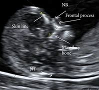 Image result for Fetal Nuchal Translucency Ultrasound