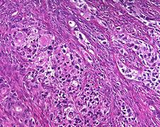 Image result for Brenner Tumor of Ovary Ultrasound