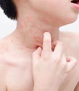 Image result for Common Skin Rash
