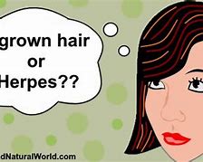 Image result for Genital Wart or Ingrown Hair