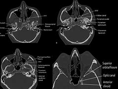 Image result for Bony Landmarks Head and Neck CT