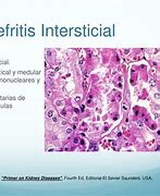 Image result for intersticial