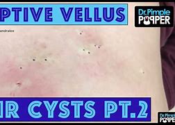 Image result for Vellus Hair Cyst eMedicine