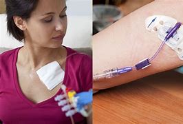 Image result for Chemotherapy PICC Line