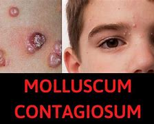 Image result for Molluscum Contagiosum Treatment for Babies