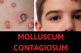 Image result for Molluscum Contagiosum On Face Treatment