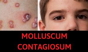 Image result for Molluscum Contagiosum Toddler