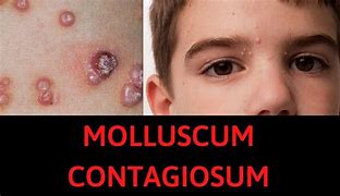 Image result for Molluscum Contagiosum Hand Out