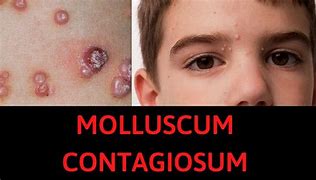 Image result for Molluscum Treatment Natural Face