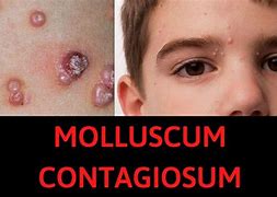 Image result for Molluscum Contagiosum Causes