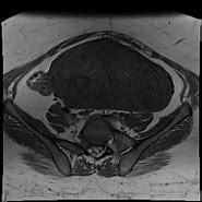 Image result for 8 Cm Uterine Fibroid
