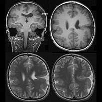 Image result for Schizencephaly