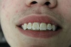 Image result for Rotten Teeth After Braces