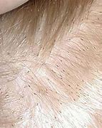 Image result for Lice in Blonde Hair