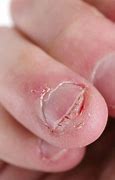 Image result for Abnormal Fingernails