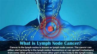 Image result for Stage 4 Cancer Lymph Nodes