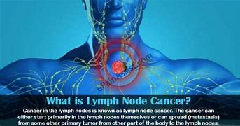 Image result for Cancer Neck Lymph Nodes