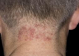 Image result for Folliculitis On Head
