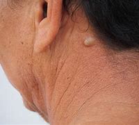 Image result for Sebaceous Cyst On Scalp