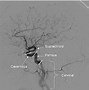 Image result for Carotid Artery Stent Ultrasound