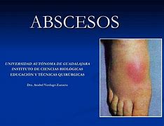 Image result for absceeo