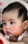 Image result for Baby Eczema Neck