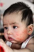 Image result for Children Skin Diseases