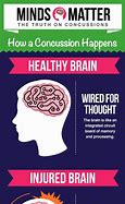 Image result for Concussion Fingers