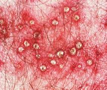 Image result for Types of Armpit Rashes